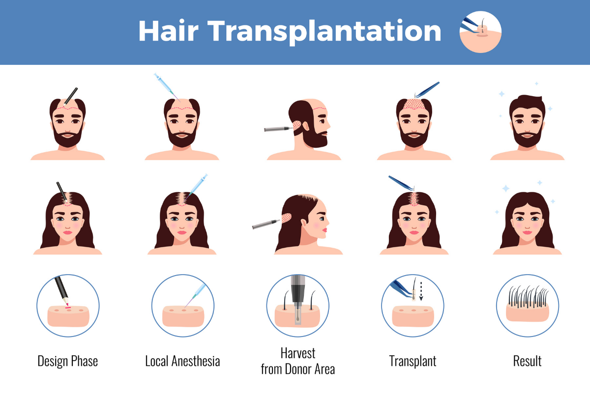 Addressing Crown Balding with Hair Transplantation: Challenges and Solutions