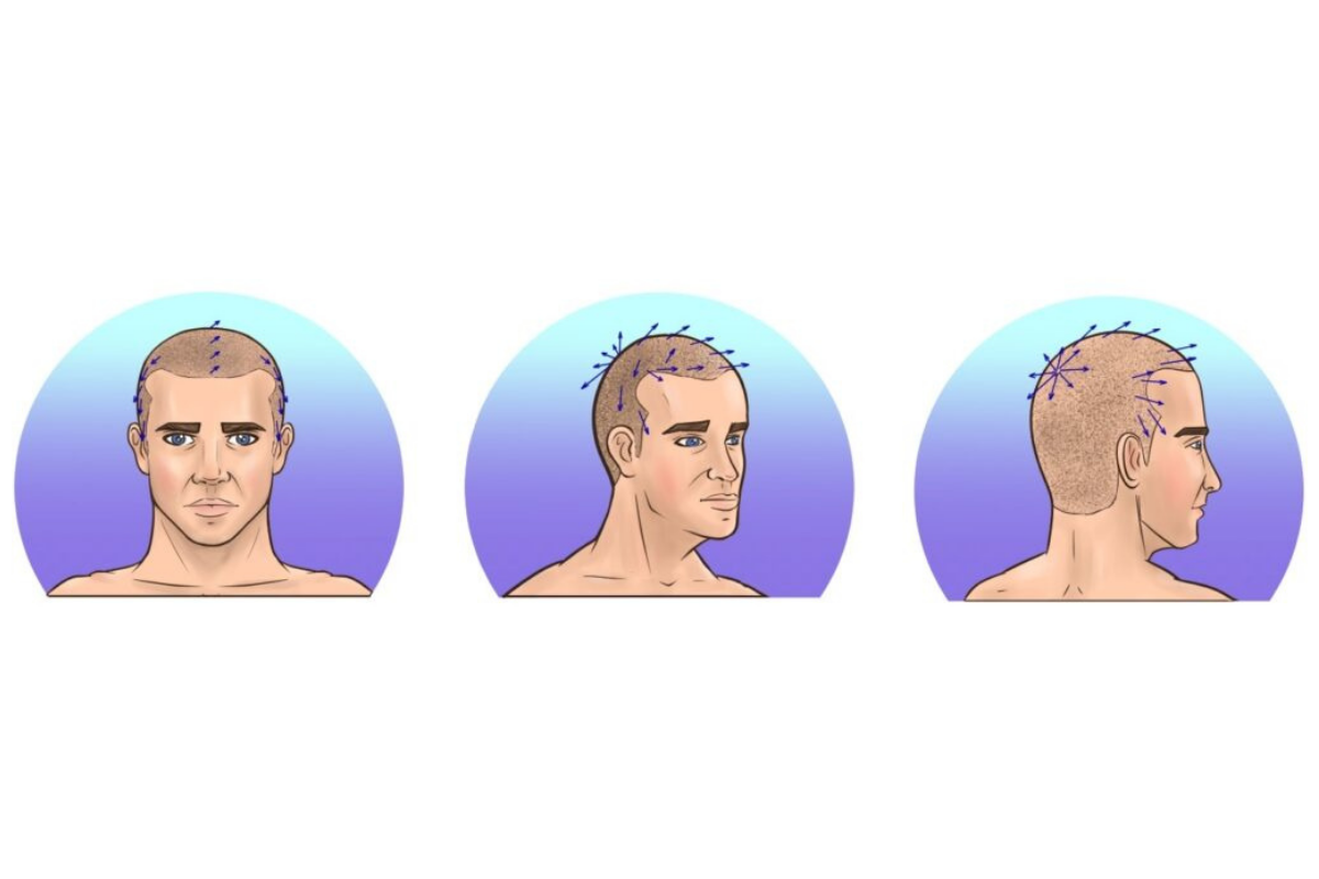 Caring for Your Hair Post-Transplant: A Guide to Protecting and Maintaining Your New Hair