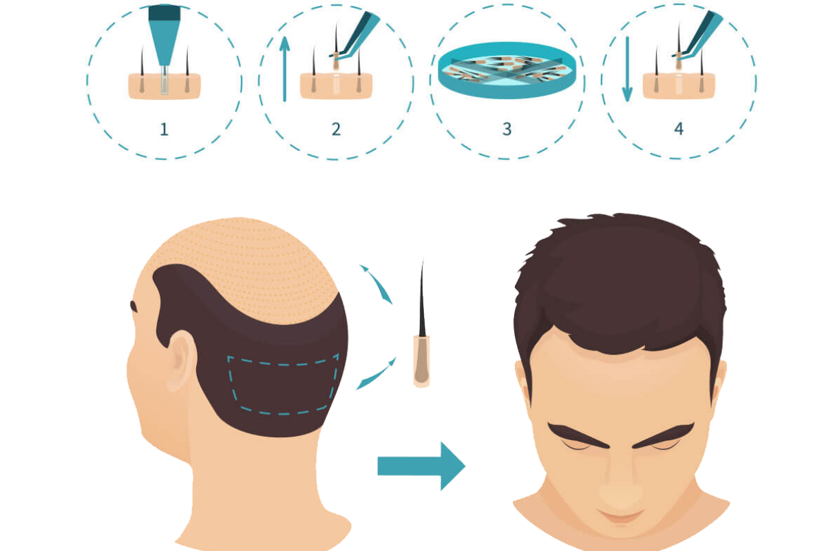 Hair Transplant Maintenance: Long-Term Care Tips to Keep Your New Hair Healthy