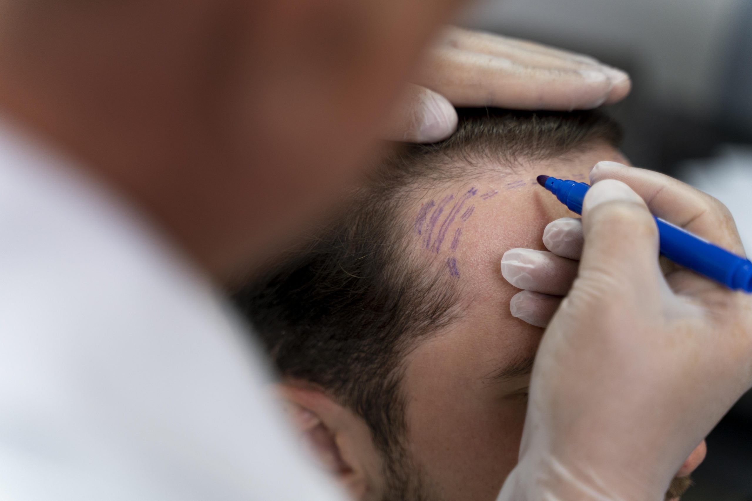 The Cost of Hair Transplants: Understanding What You’re Paying For