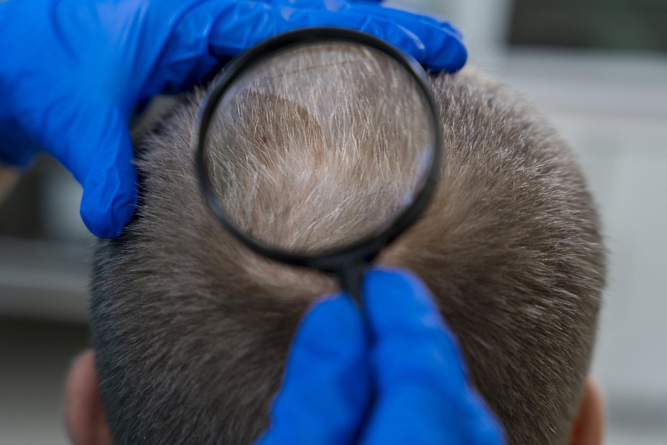Hair Transplantation for Women: Key Differences in Approach and Expectations